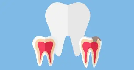 como evitar cáries nos dentes